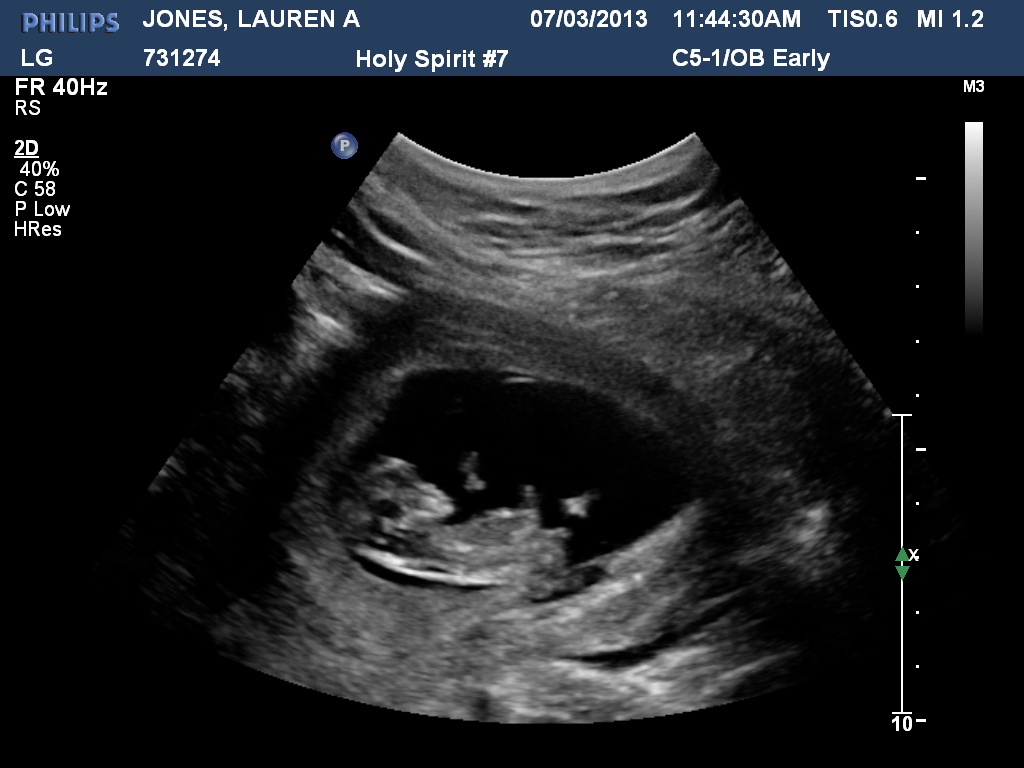 How Accurate Is A Dating Ultrasound At 11 Weeks