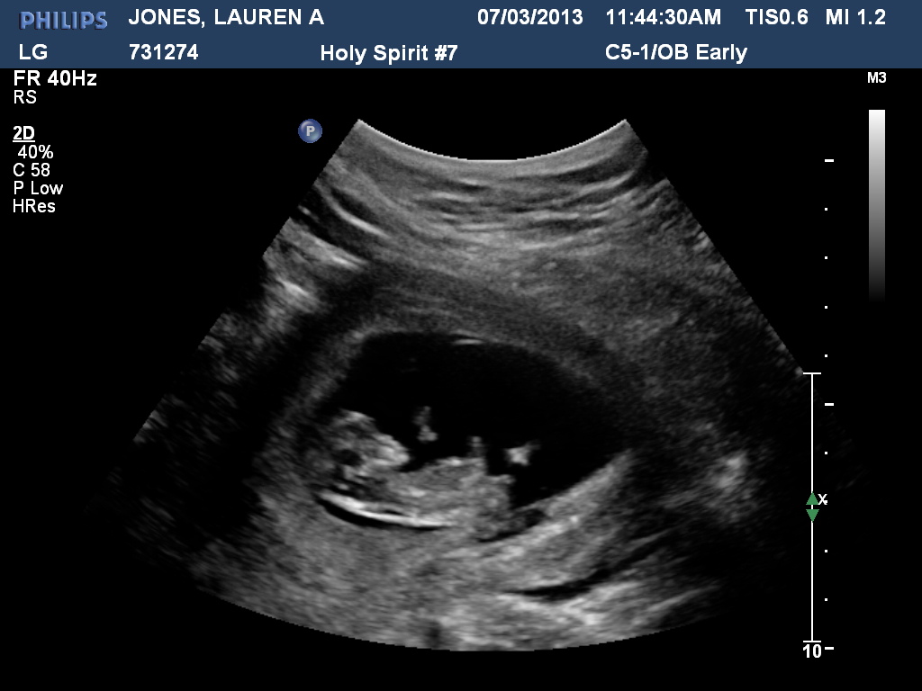 normal heartbeat at 10 weeks